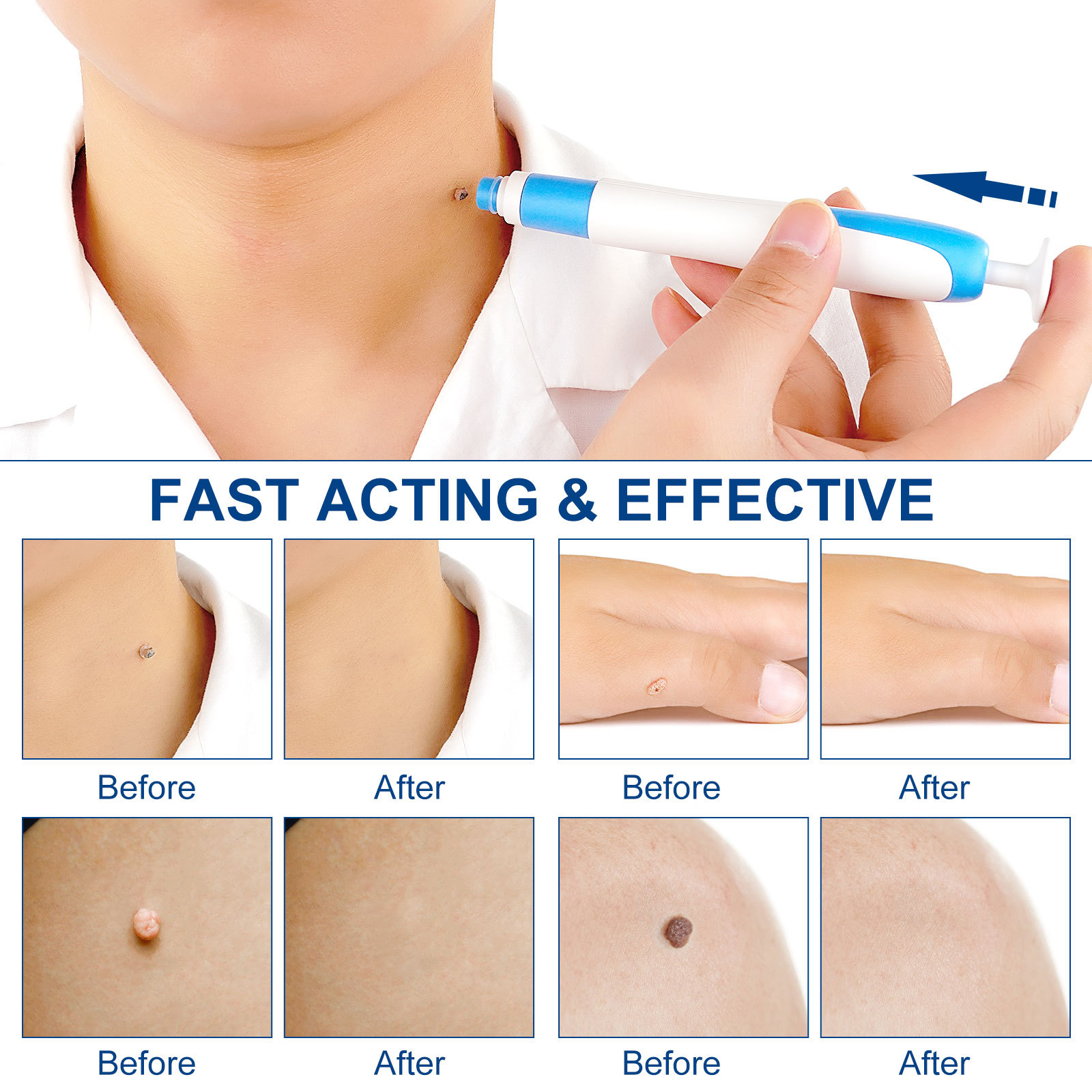 2-IN-1 Auto Skin Tag Removal K - огляд і ціна Skincare Ingredients Checker